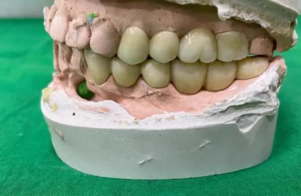 CAD/CAM Monolithic Zirconia Precision Milling and Prosthodontic Restoration at Myla Dental Care Guntur