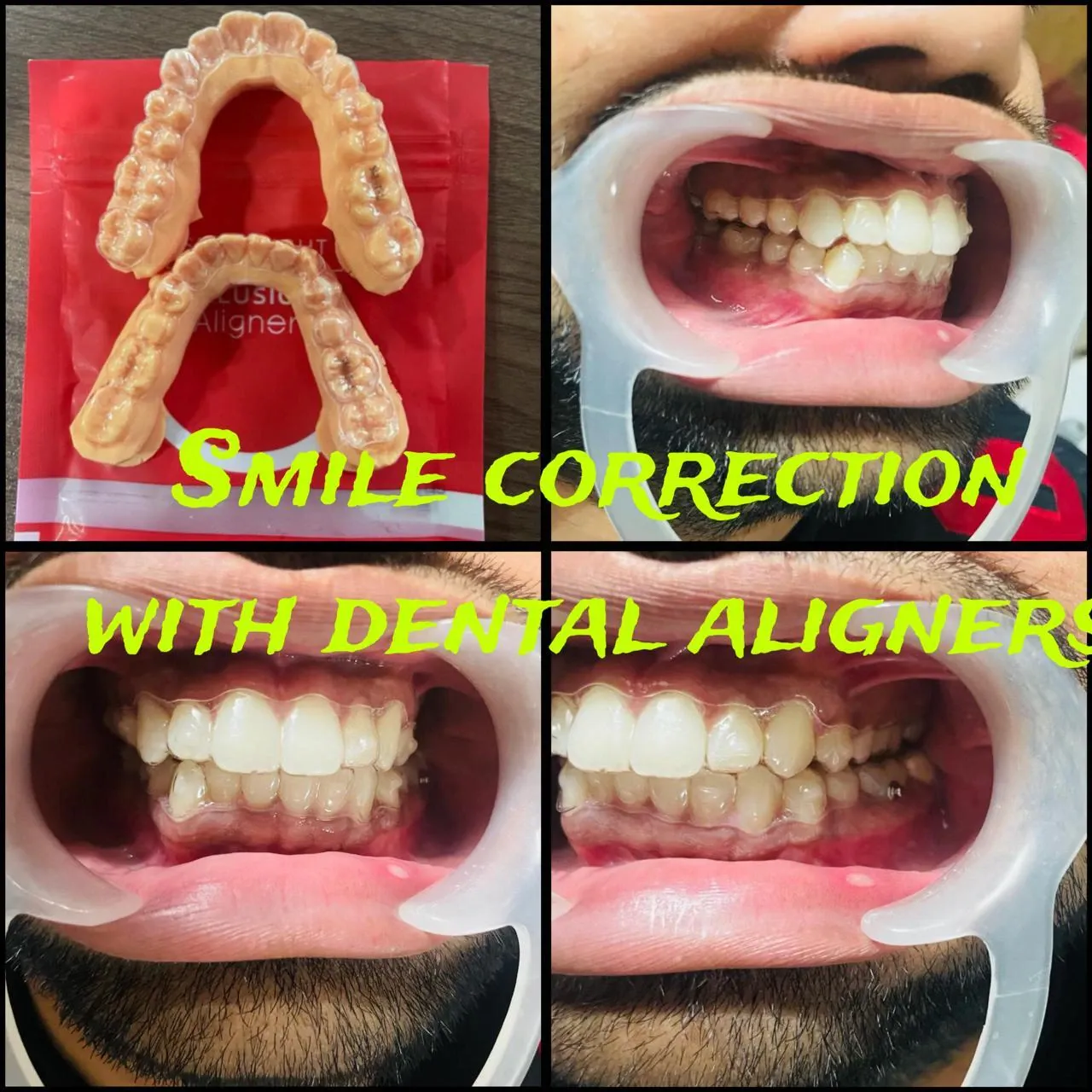 Invisible Clear Aligners Guntur