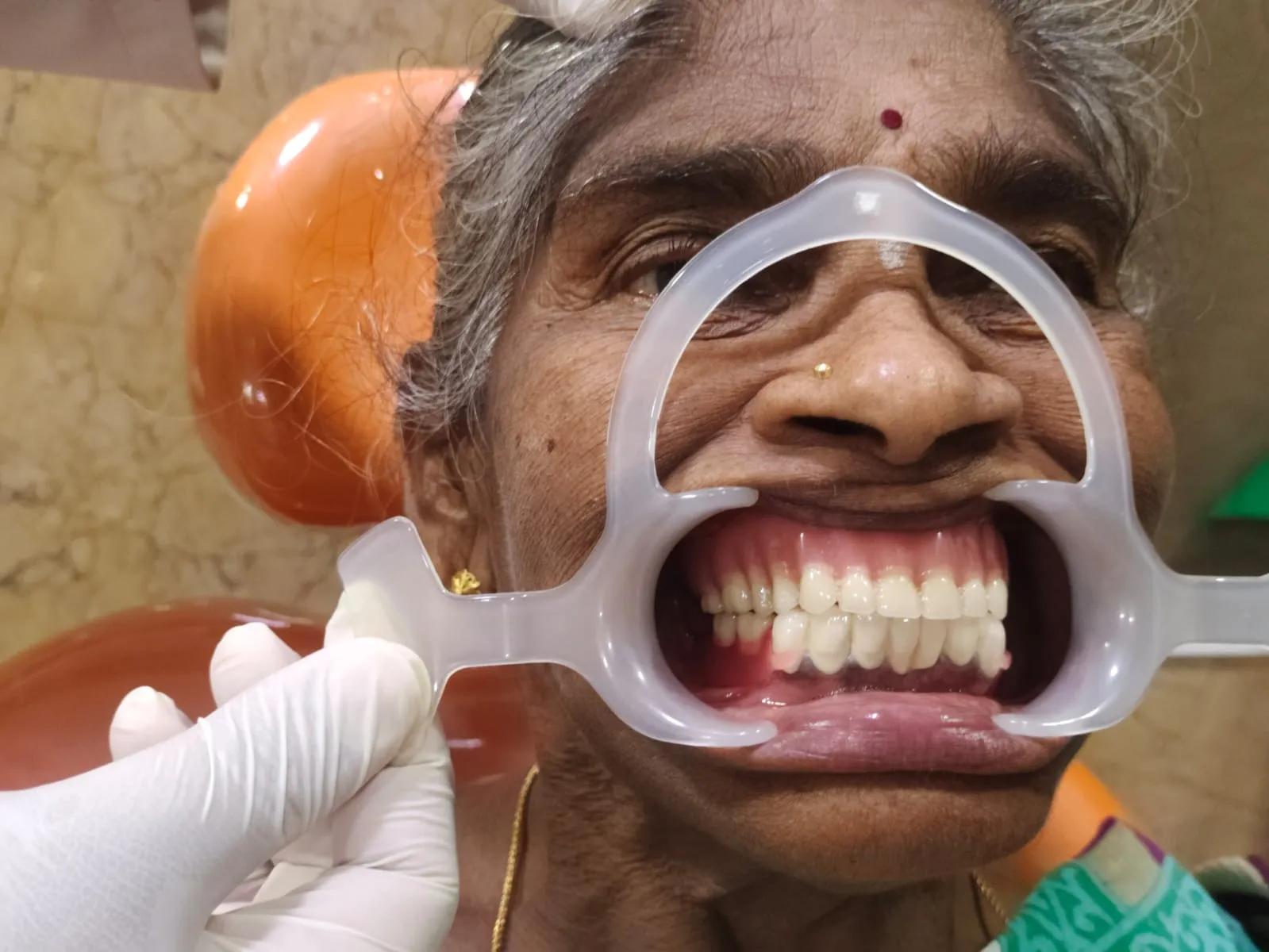 Complete upper and lower denture rehabilitation restoring smile aesthetics for elderly patient