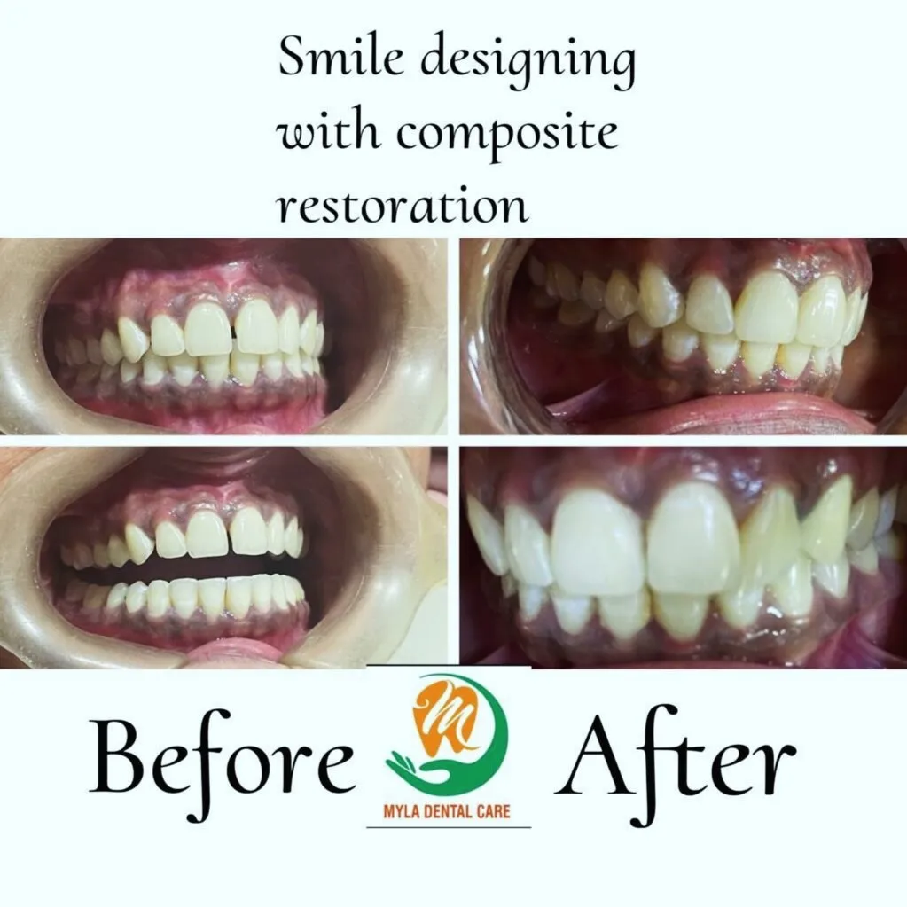 4-panel before and after direct composite veneer smile designing at Myla Dental Care