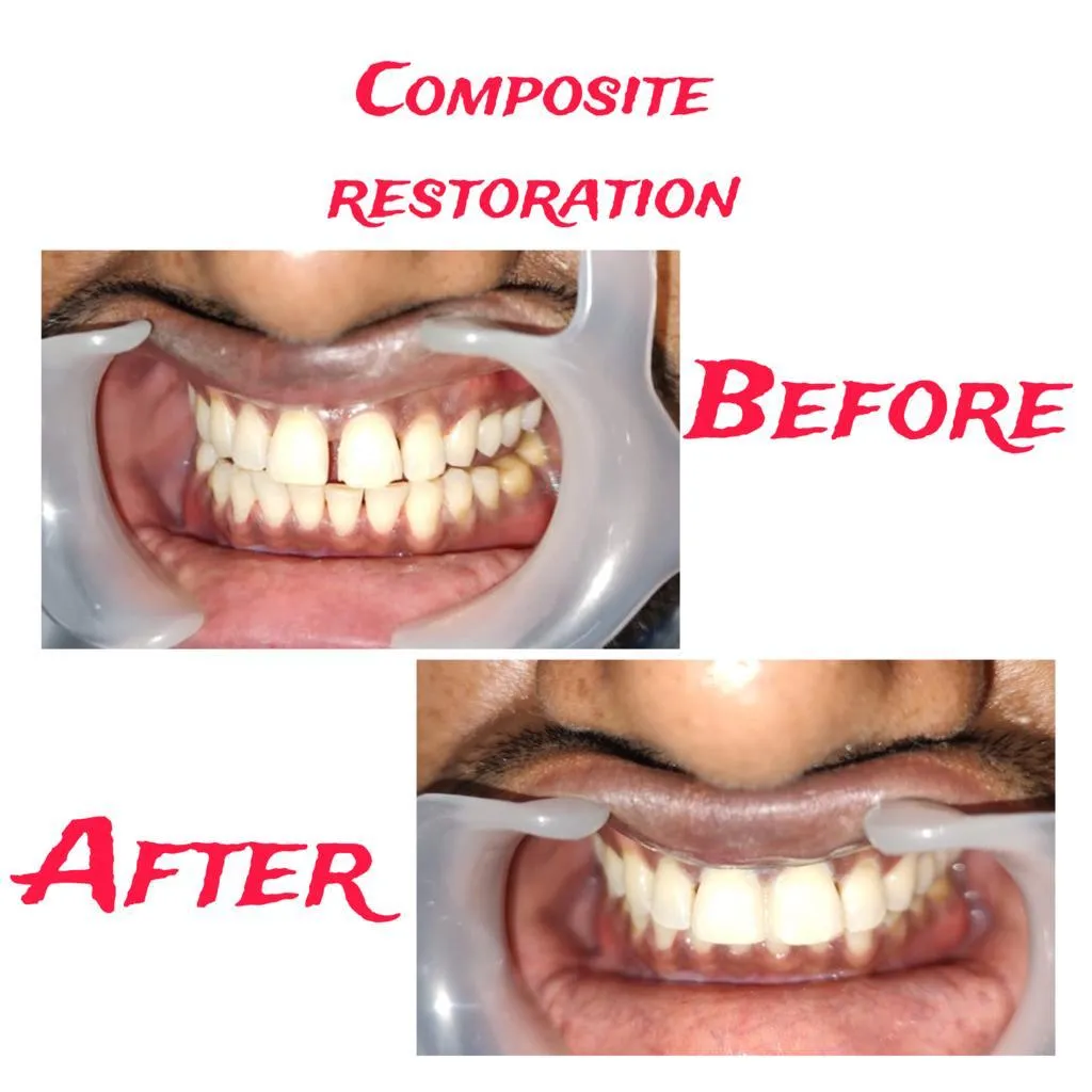 Before and after direct composite veneer smile designing at Myla Dental Care Guntur