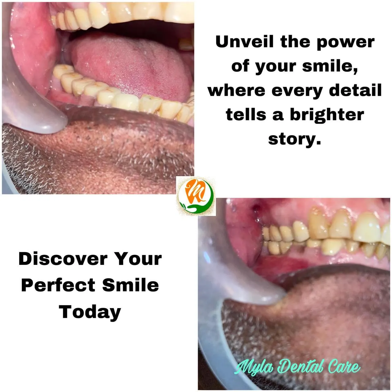 Cosmetic smile makeover and dental veneer transformation poster at Myla Dental Care