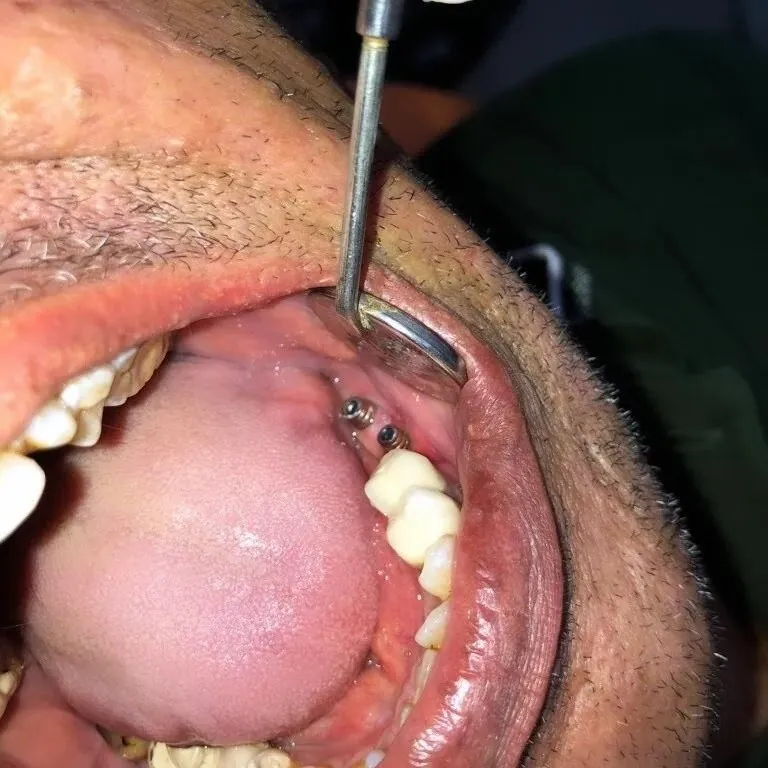 Intraoral view of titanium dental implant abutments placed in posterior maxilla