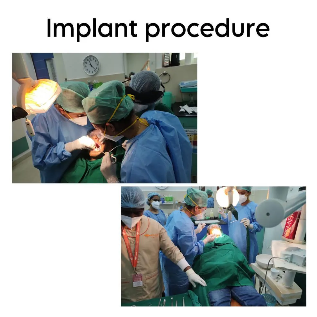 Titanium Dental Implants Guntur