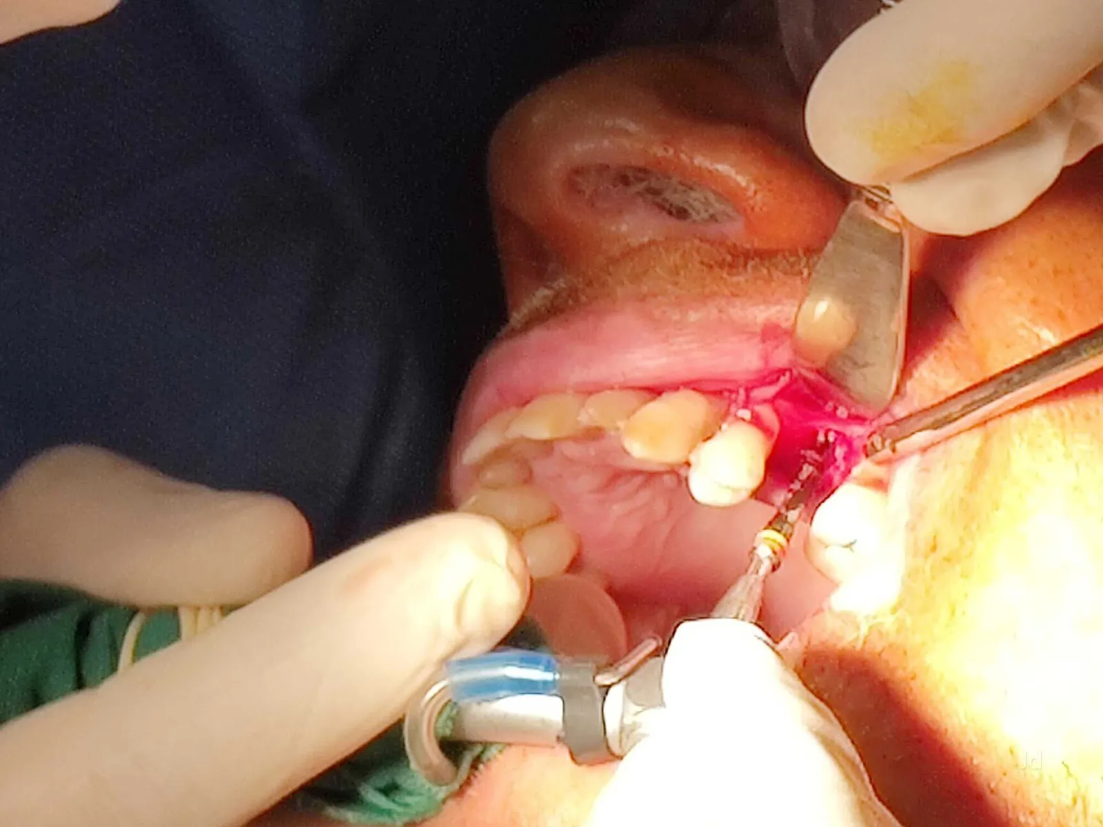 Close-up of sterile surgical dental implant placement procedure at Myla Dental Care Guntur