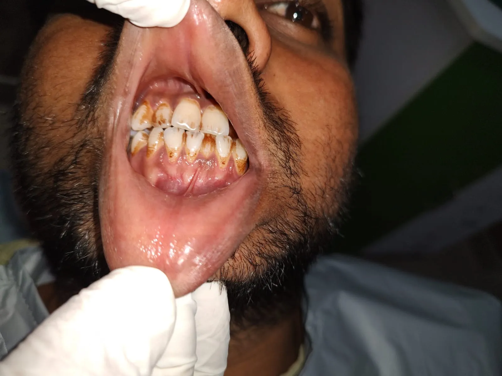 Intraoral diagnostic view of dental plaque and calculus buildup on anterior teeth