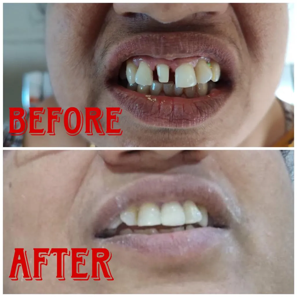 Before and after cosmetic diastema gap closure smile makeover at Myla Dental Care Guntur