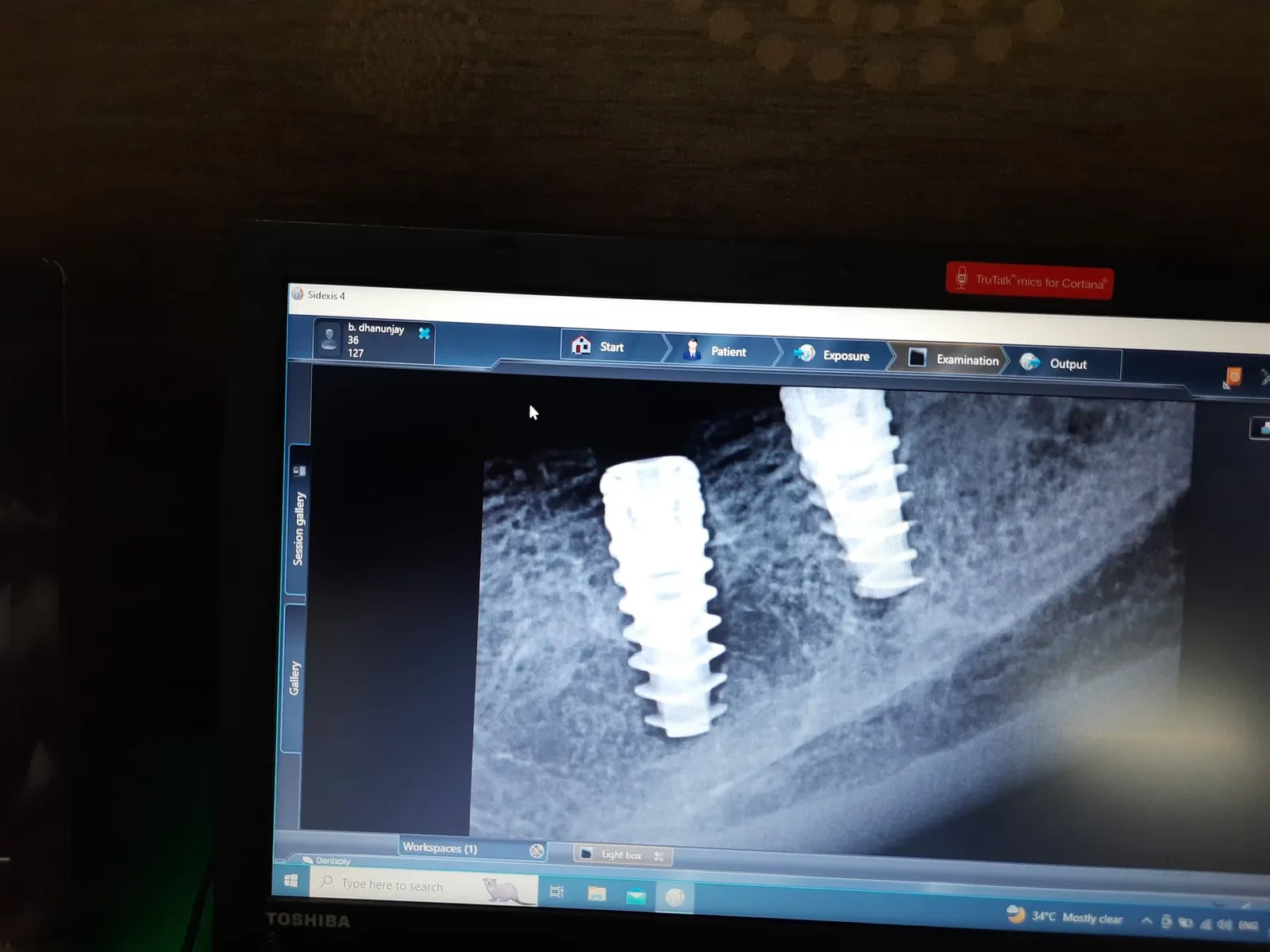 High-resolution digital RVG dental X-ray showing two osseointegrated titanium implants