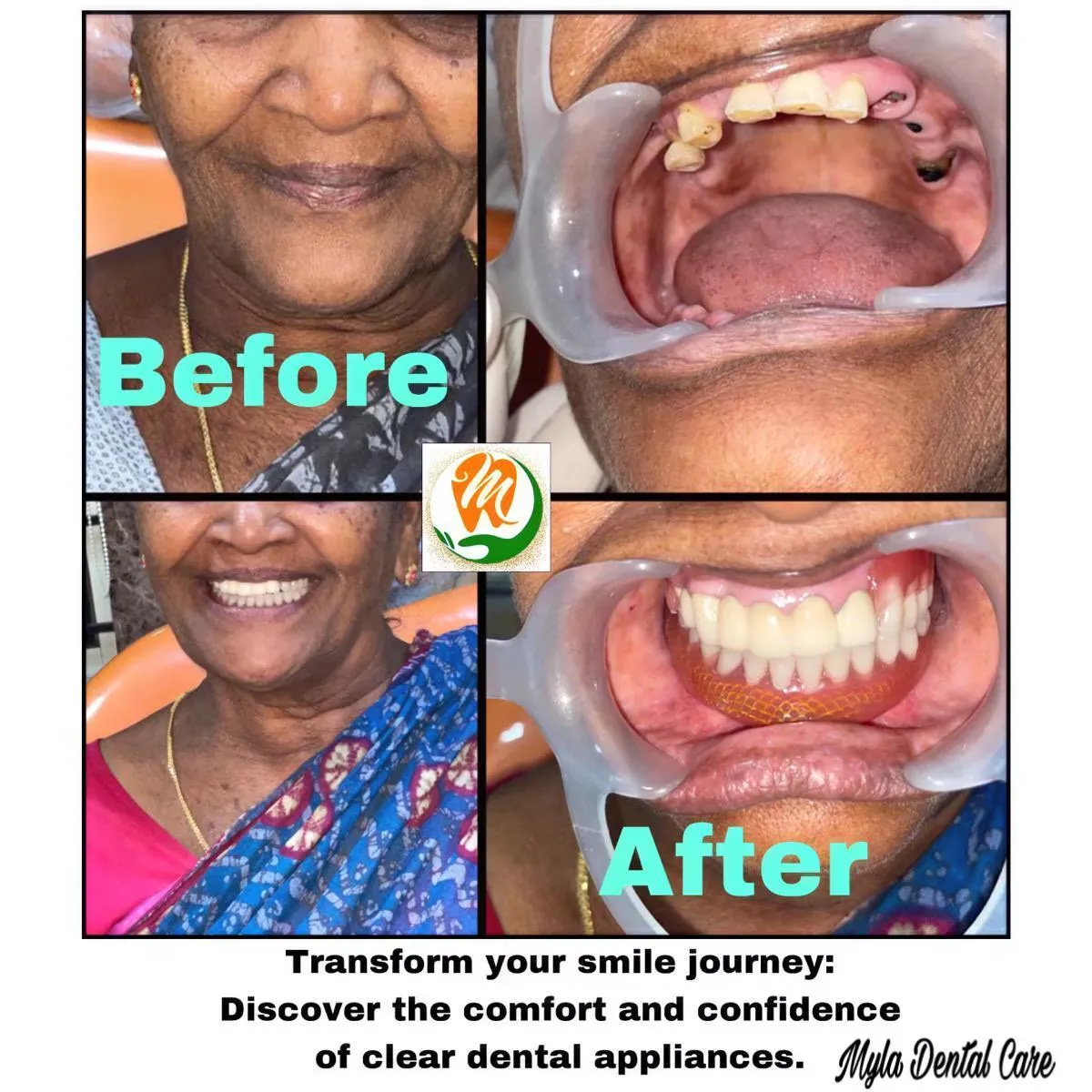 Before and after full mouth denture restoration for completely edentulous elderly patient