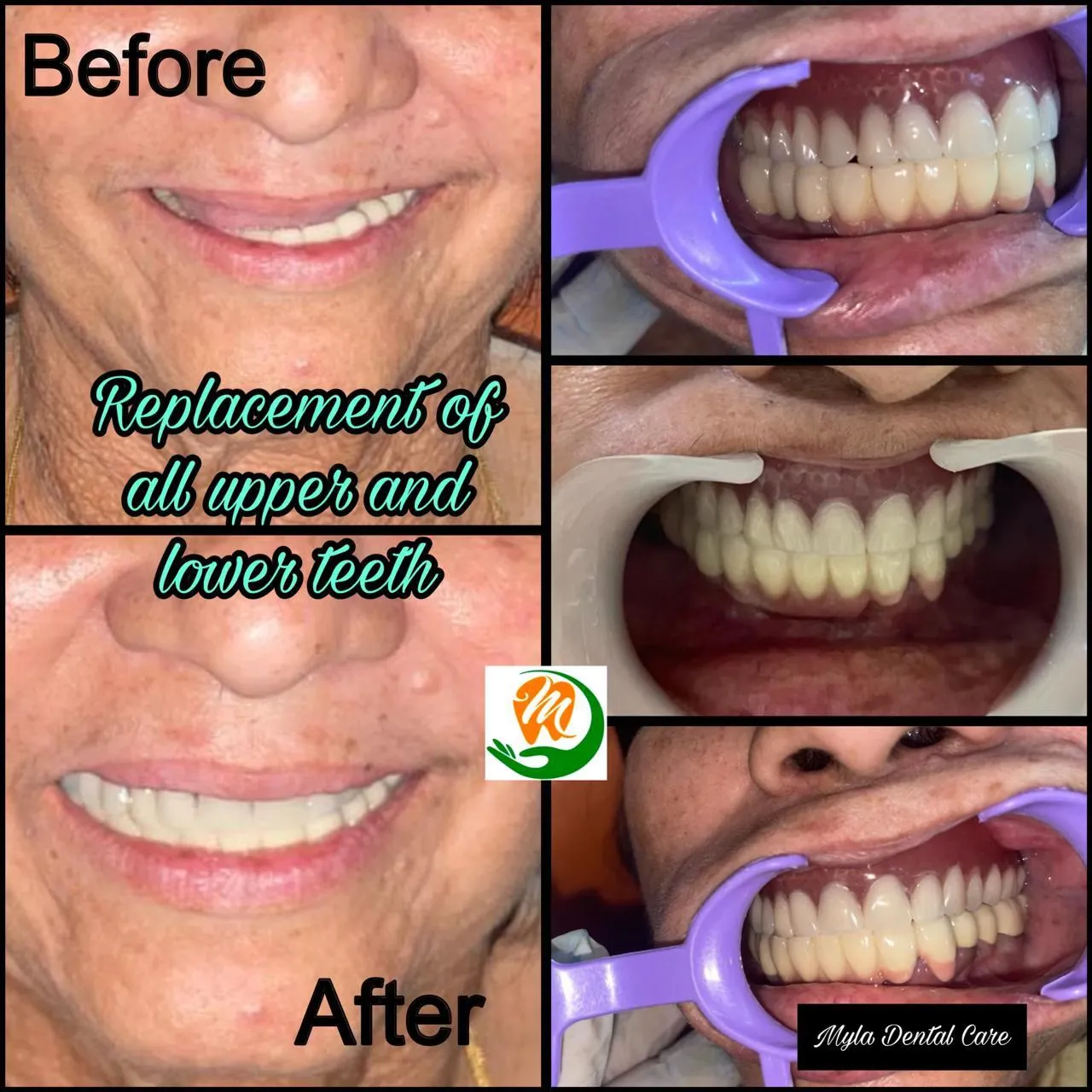 Before and after comprehensive full mouth upper and lower prosthetic rehabilitation