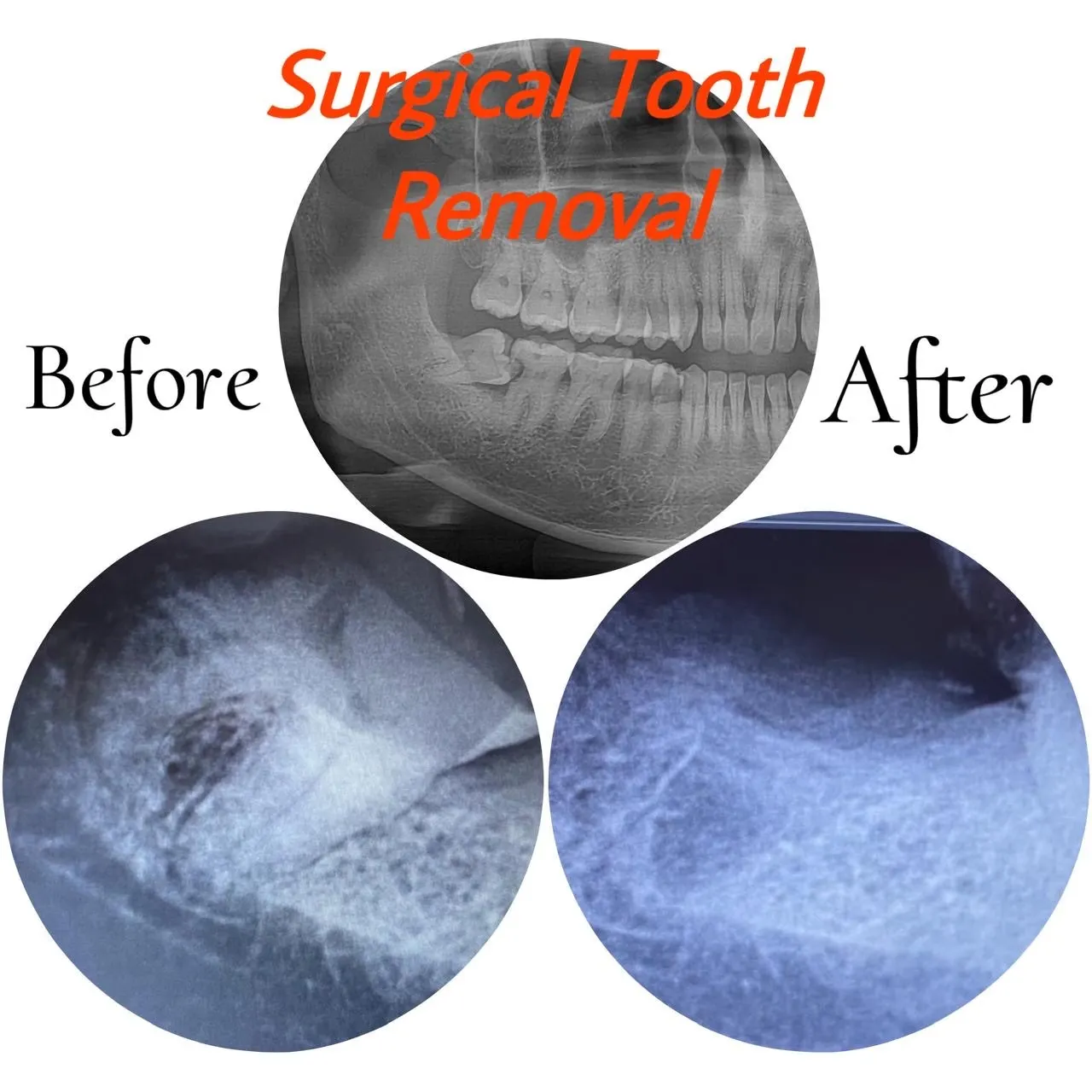 Painless Wisdom Tooth Extraction Guntur