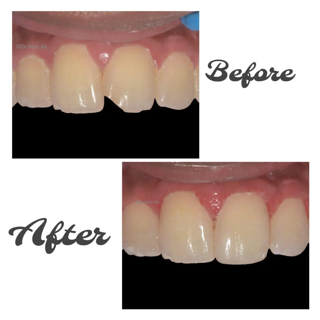 Before and after composite bonding repair for chipped incisal edges at Myla Dental Care