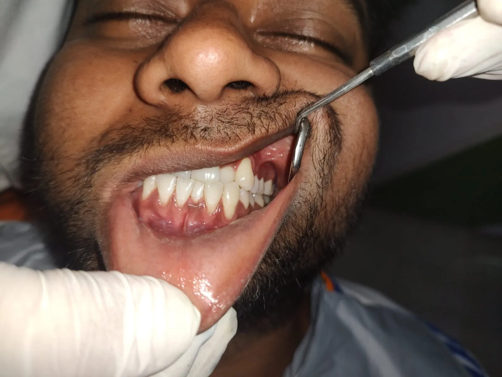 Intraoral dental examination checking teeth alignment and bite at Myla Dental Care Guntur