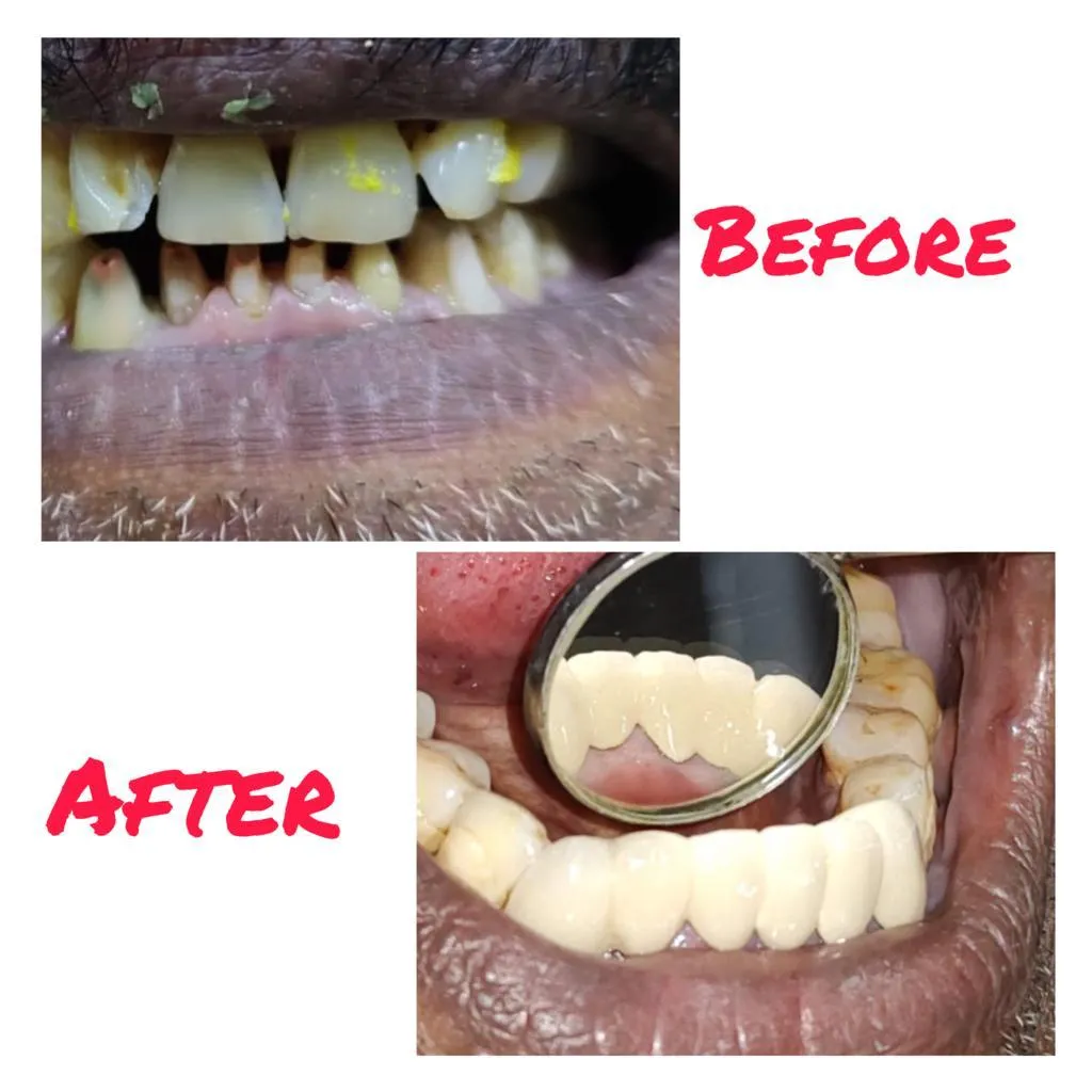 Before and after lingual calculus debridement and molar restoration at Myla Dental Care