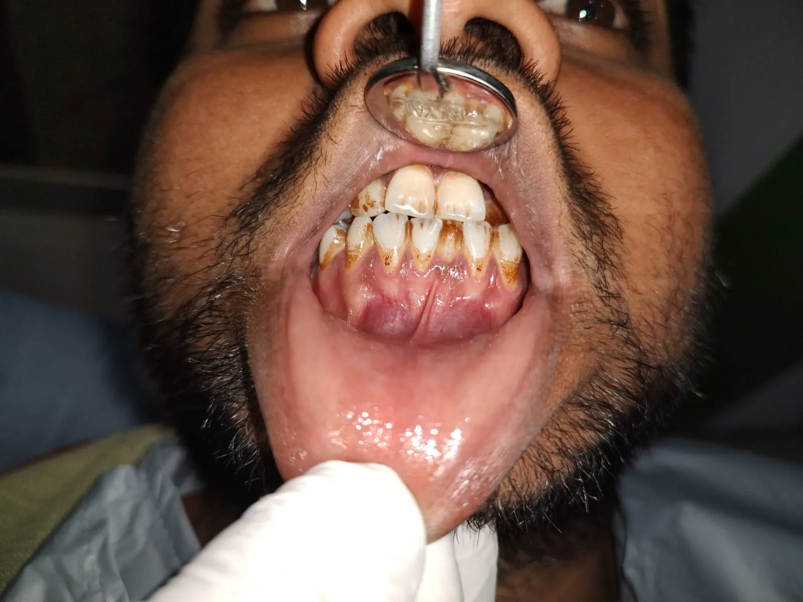 Severe subgingival calculus and tartar buildup before ultrasonic scaling at Myla Dental Care Guntur