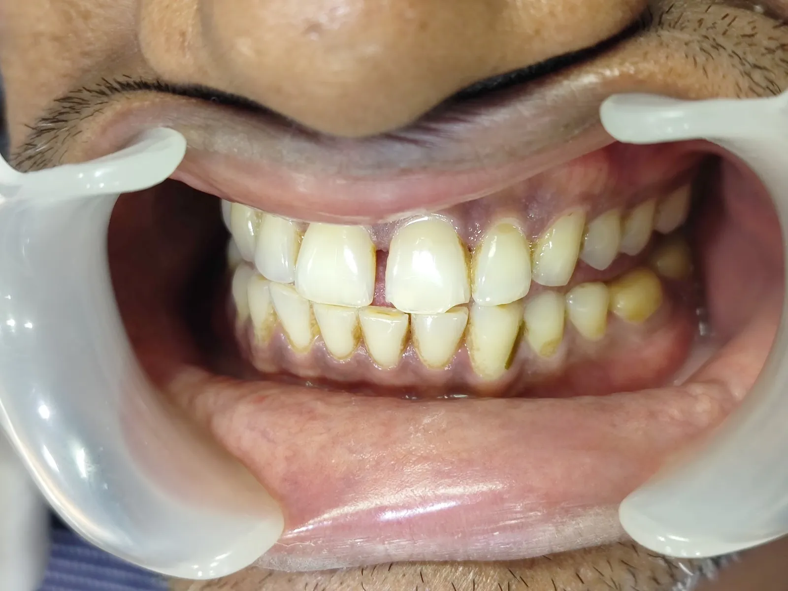 Intraoral retraction view showing upper maxillary dental arch teeth alignment