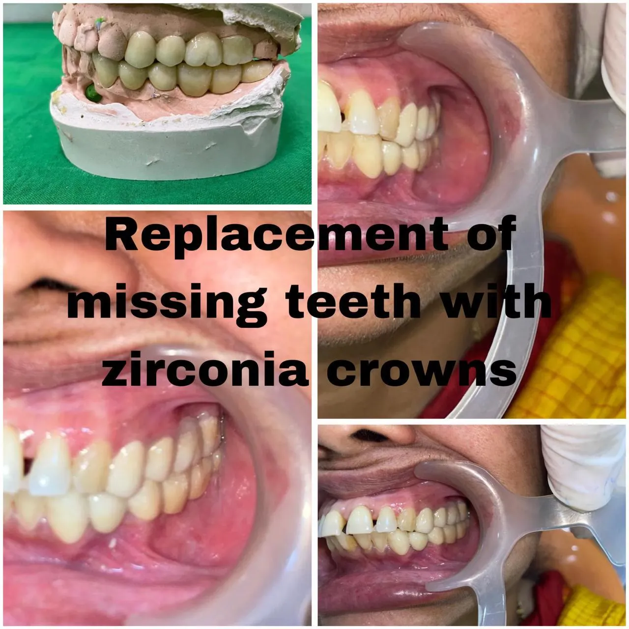 Before and after replacement of missing anterior teeth with premium zirconia crowns and cast model