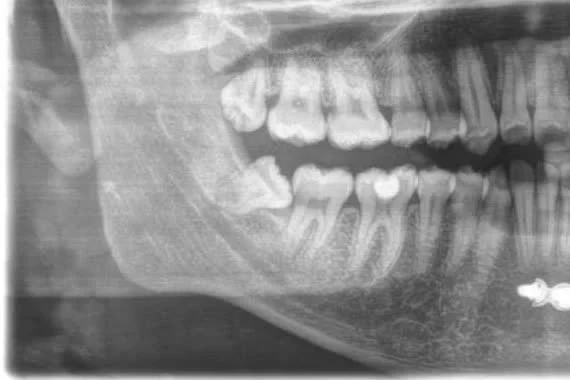Digital Panoramic OPG Radiograph for Wisdom Tooth Anatomical Planning at Myla Dental Care Guntur
