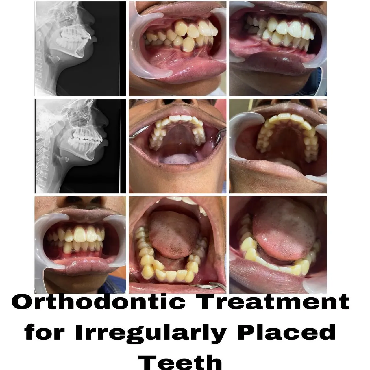 Before and after orthodontic braces alignment for crowded irregular teeth with cephalometric X-ray