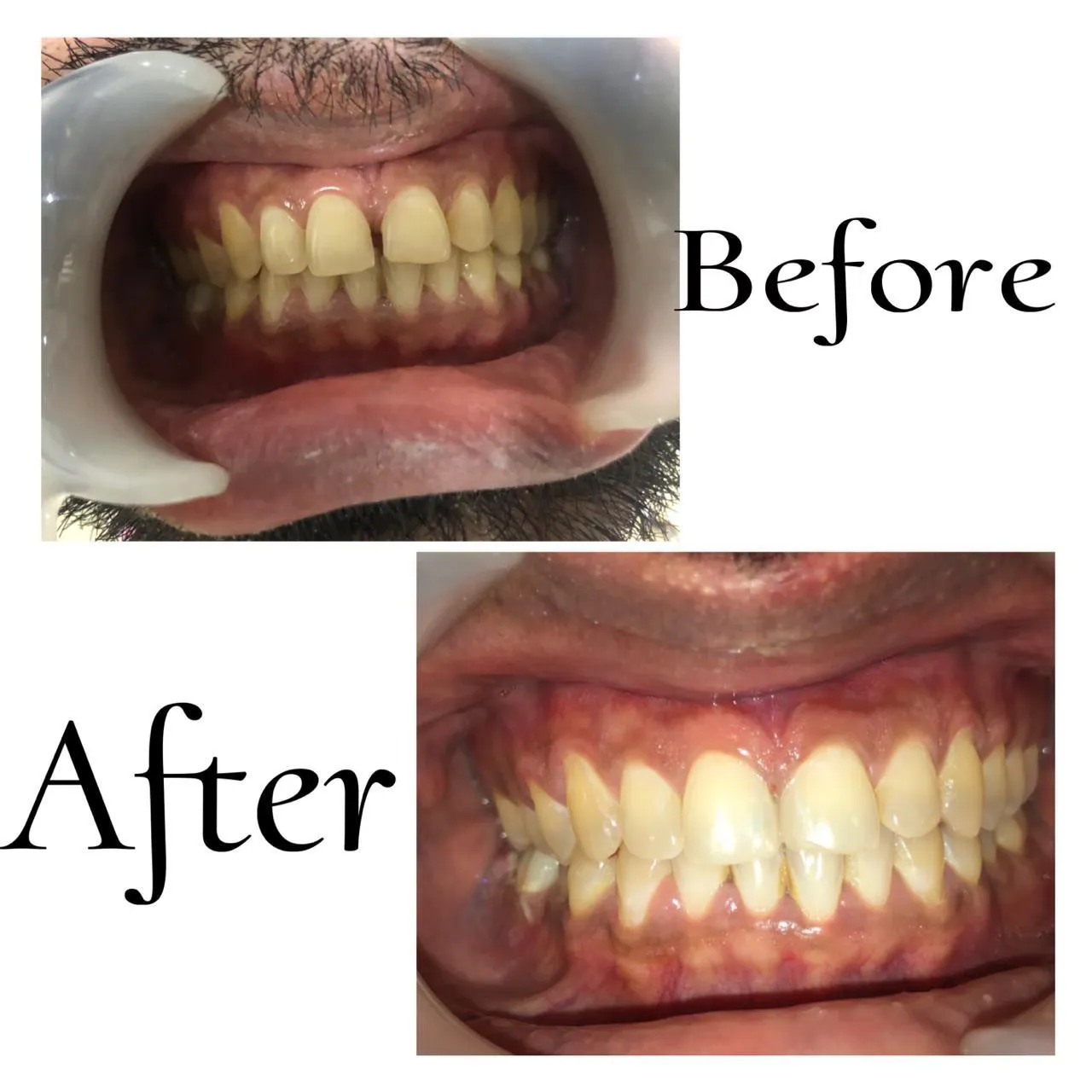 Laser Gum Care & Deep Scaling Guntur