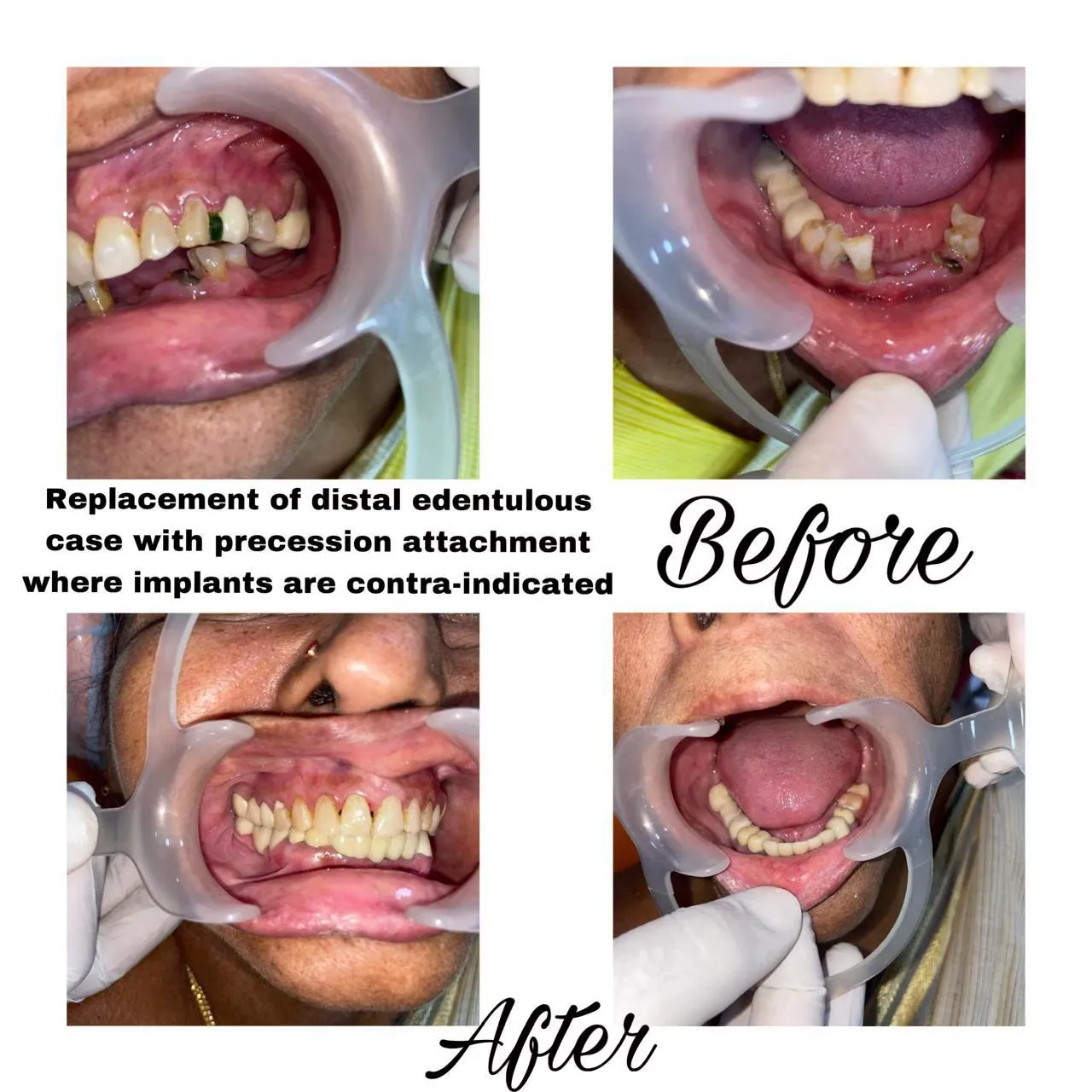 Before and after precision attachment cast partial denture for bilateral distal edentulous spaces