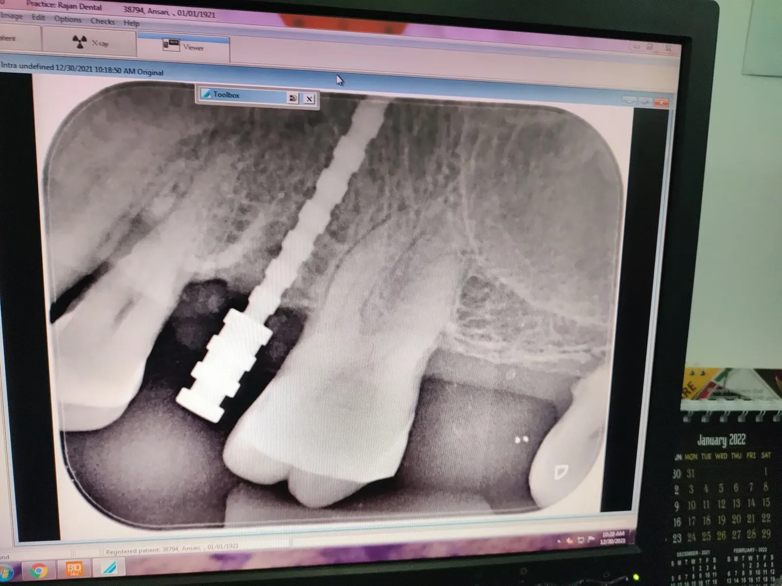 Single Sitting Root Canal Treatment Guntur