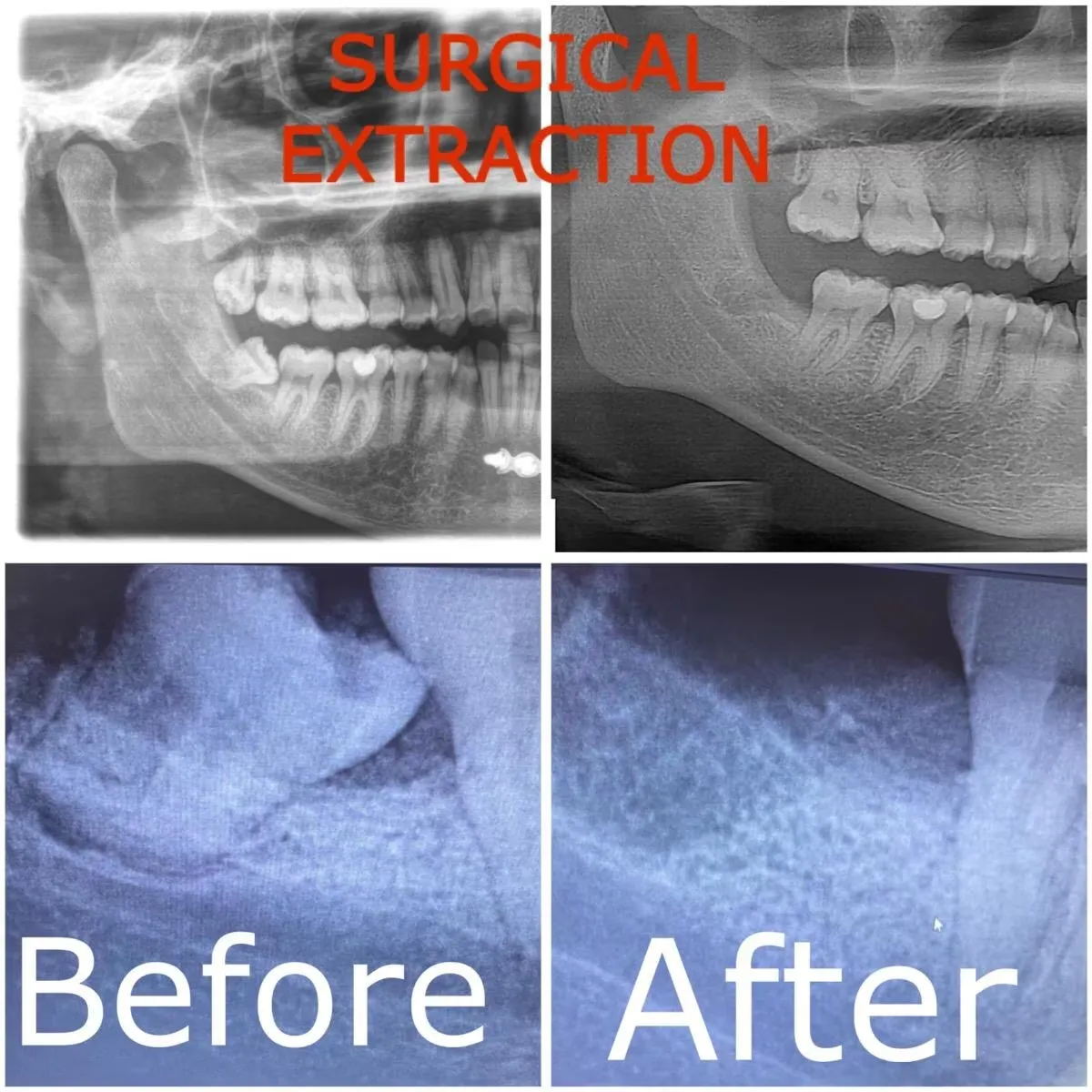 Pre-operative and post-operative OPG X-ray demonstrating bone healing after surgical extraction