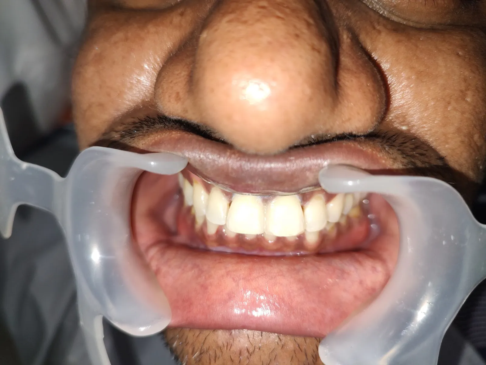 Intraoral view of surgical extraction and socket preservation at Myla Dental Care