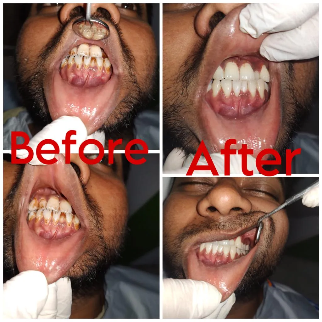 Before and after comparison of dental scaling and stain removal at Myla Dental Care Guntur