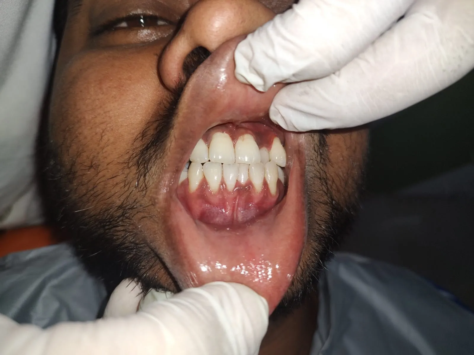 Clean teeth and healthy pink gums following professional ultrasonic scaling at Myla Dental Care