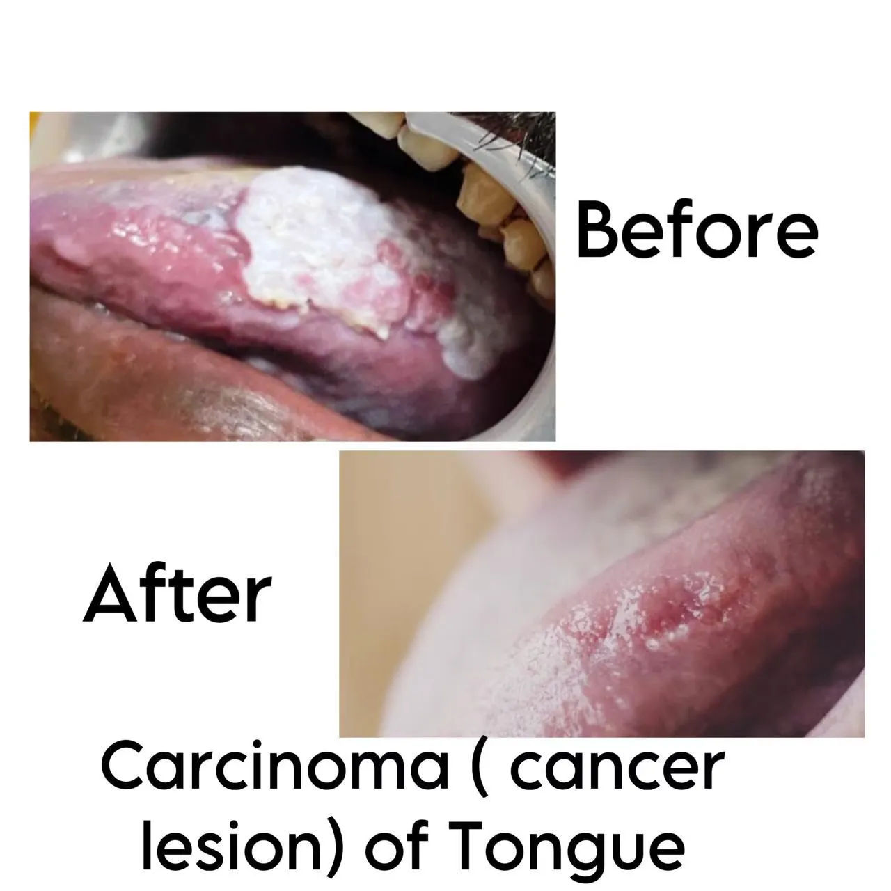 Clinical before and after pathology documentation of tongue carcinoma lesion healing