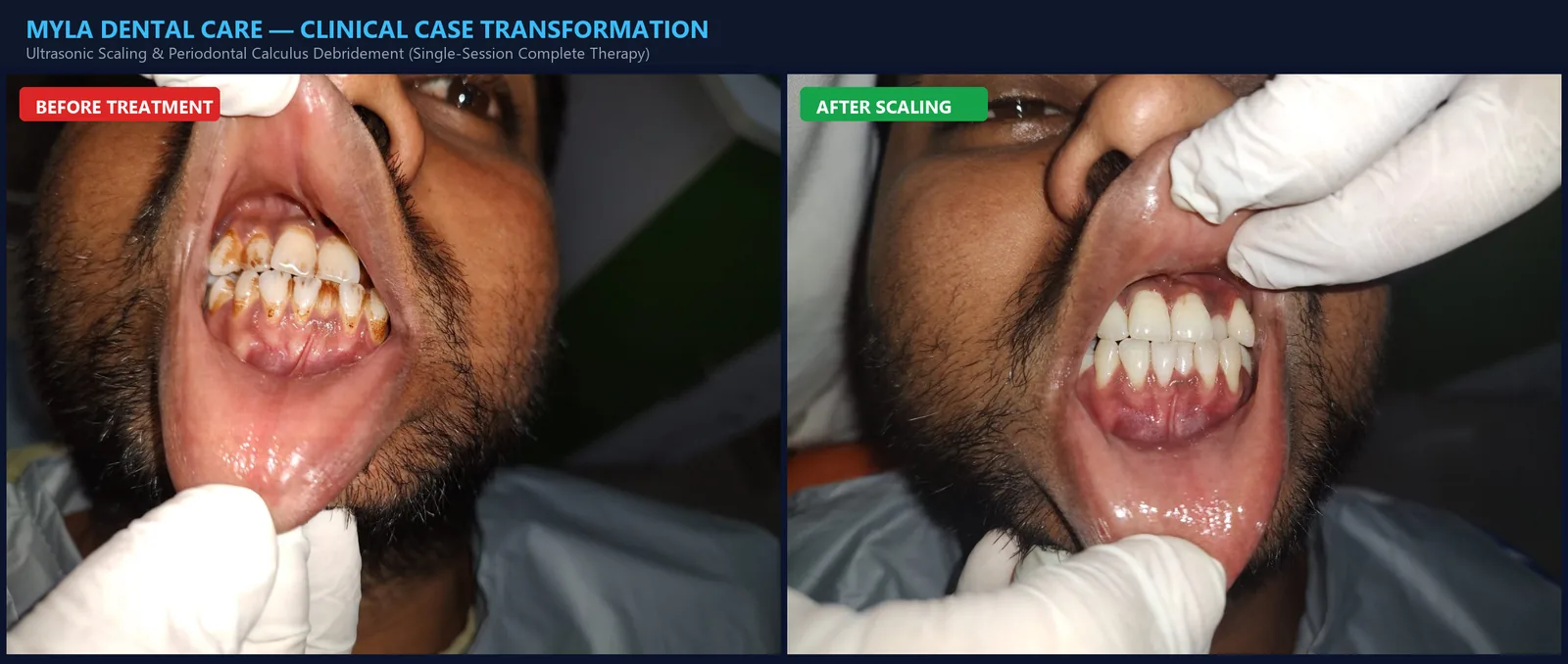 Laser Teeth Whitening Guntur
