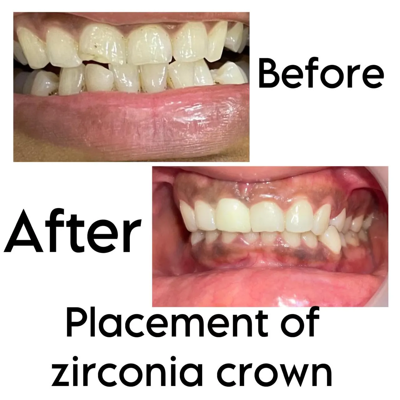Monolithic Zirconia Dental Crown Guntur